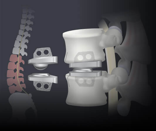 Artificial Disc Replacement