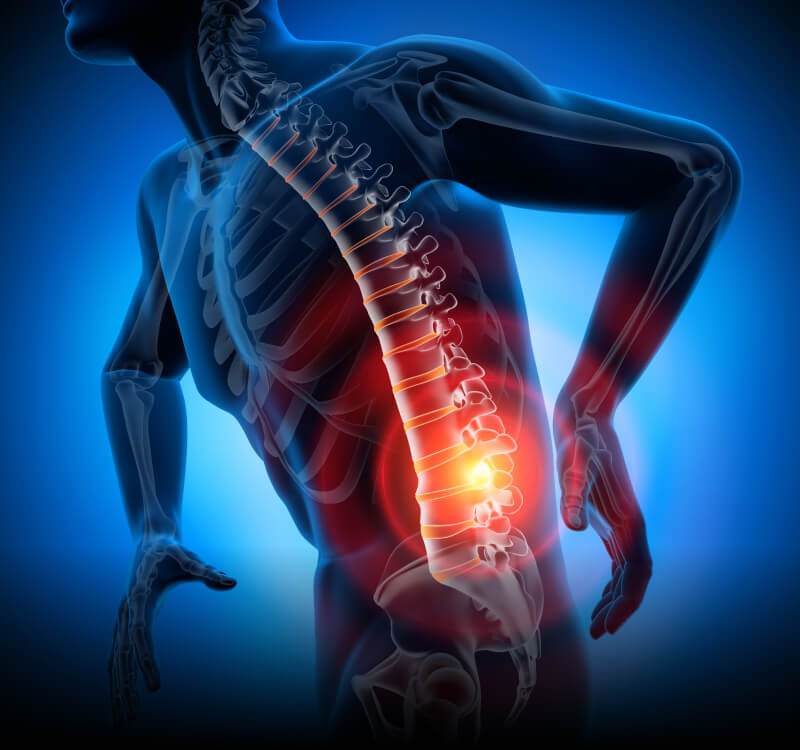 Disc Herniation