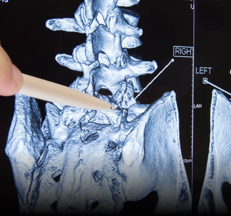 Lumbar Radiculopathy