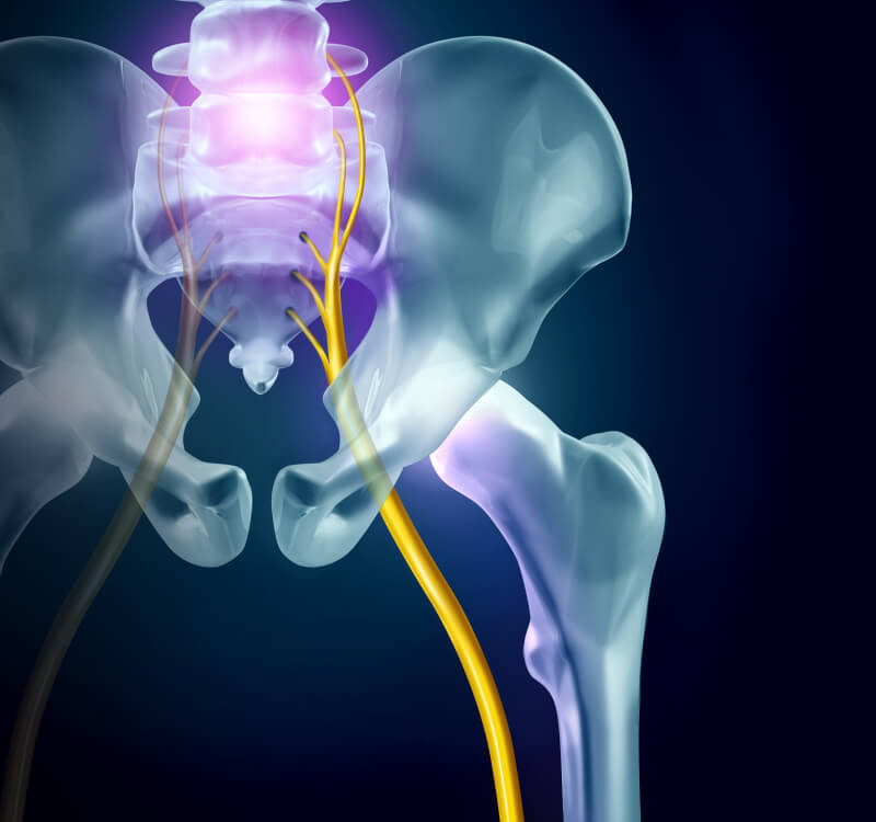 Sciatica