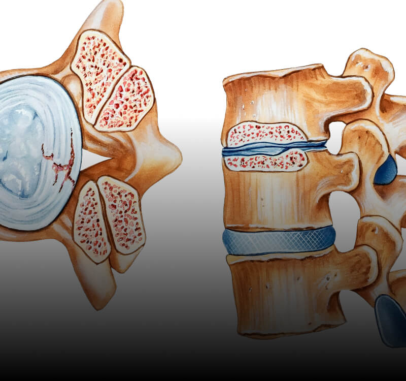 CERVICAL DISC DEGENERATION
