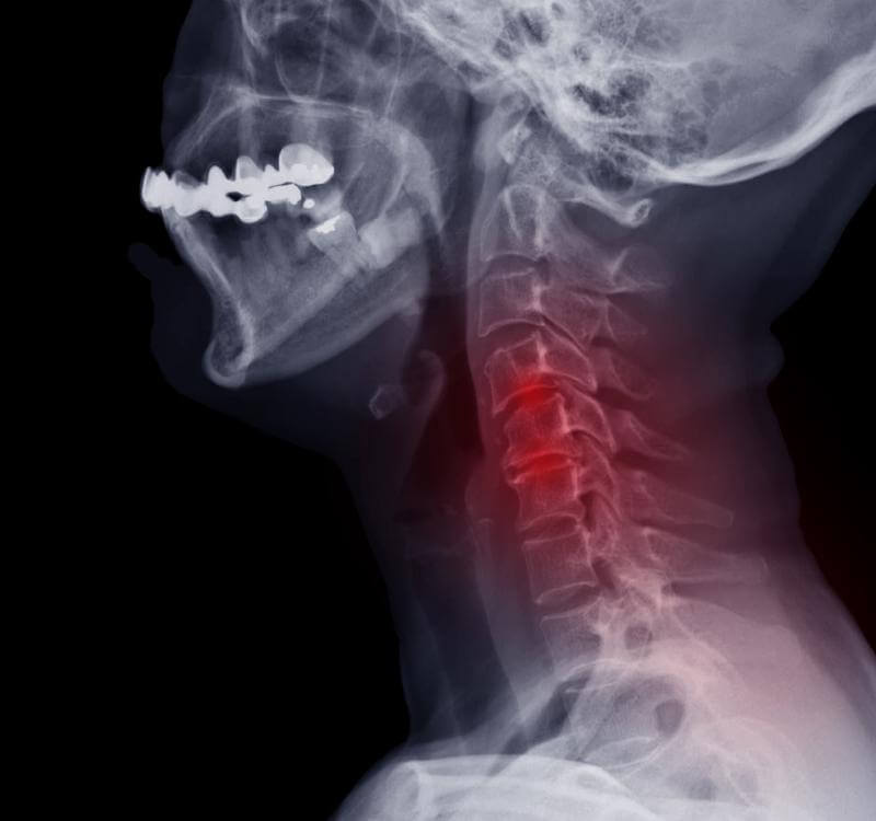 Cervical Disc Disease