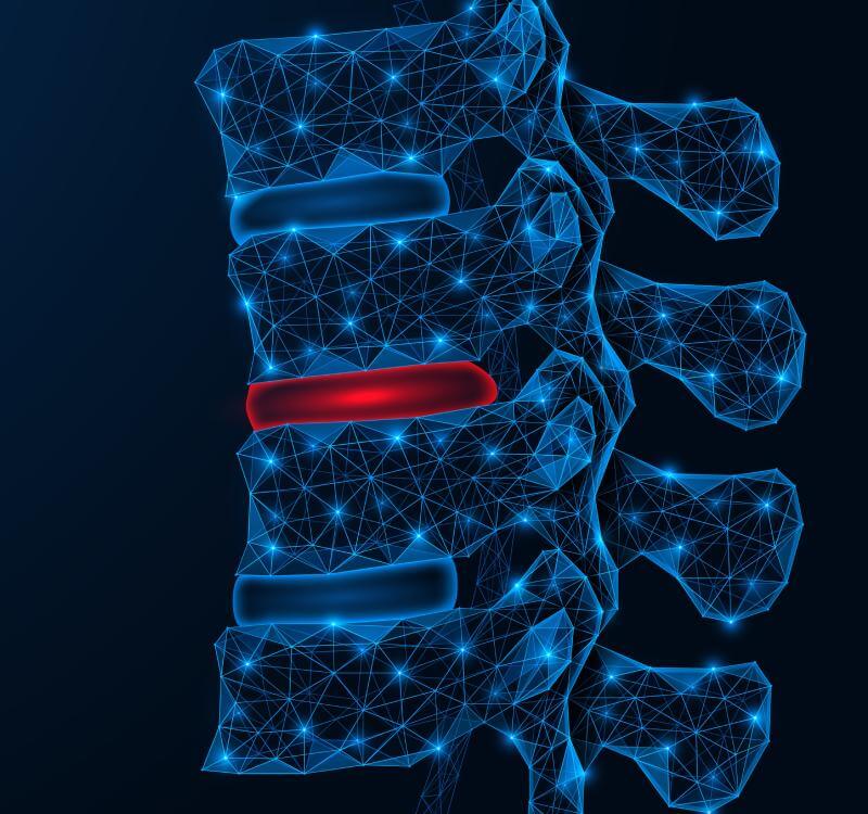 Cervical Herniated Disc