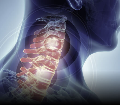 Cervical Myolopathy