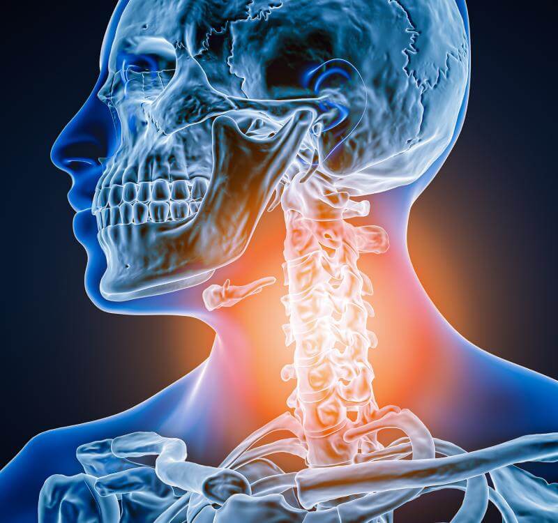Cervical Radiculopathy