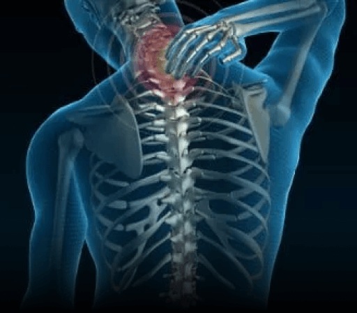 Cervical Stenosis