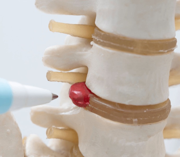 Disc Problems Diagnosis