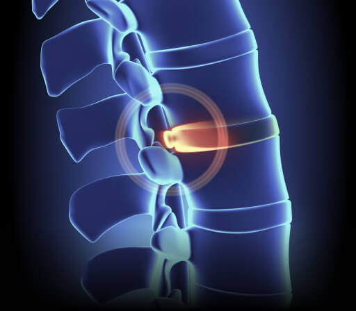 Disk Herniation