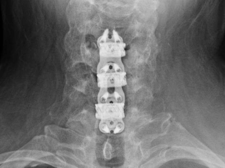 Patient 3 after fusion 1