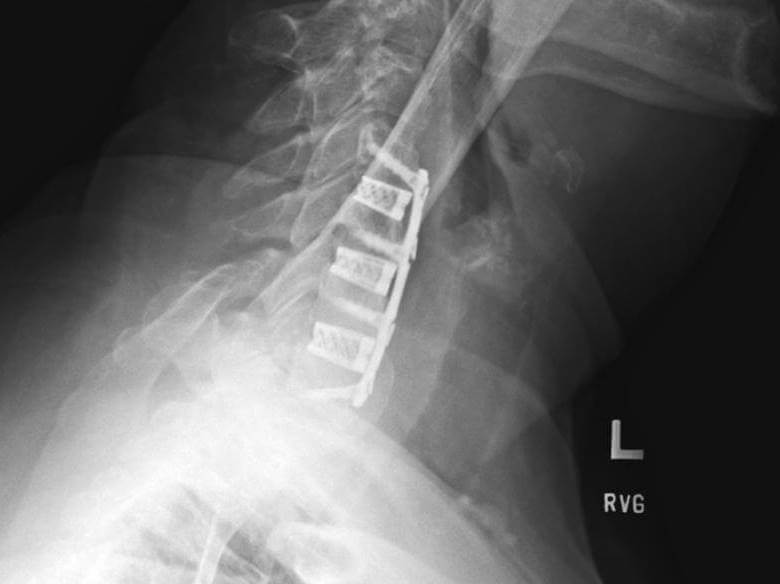 Patient 3 after fusion 1
