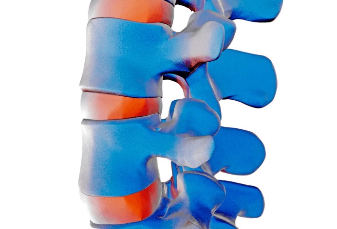 Lumbar Radiculopathy Diagnosis