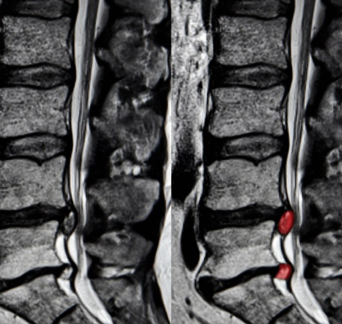 Lumbar Radiculopathy Treatment