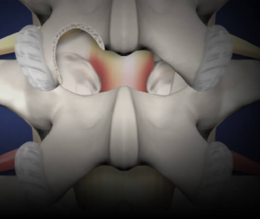 Microtube Spine Surgery