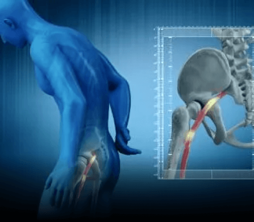 Radiculopathy