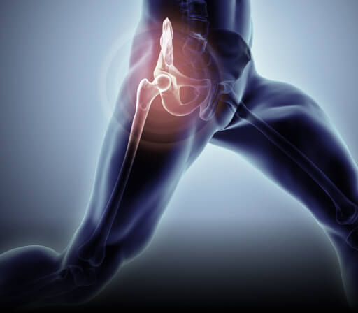 Radiculopathy