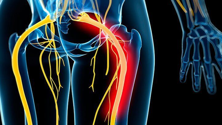 Sciatica Symptoms and Diagnosis class=