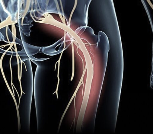 Sciatica