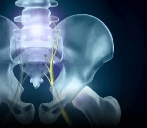 Sciatica
