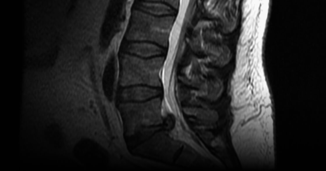 spinal radiological assessment 2nd-dimension