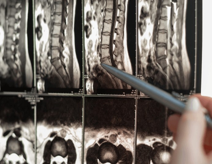 Spinal Stenosis Risk Factors