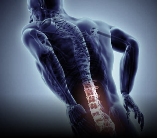 Spinal Stenosis
