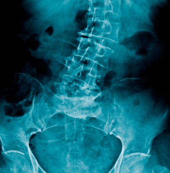 Symptoms of Lumbar Radiculopathy
