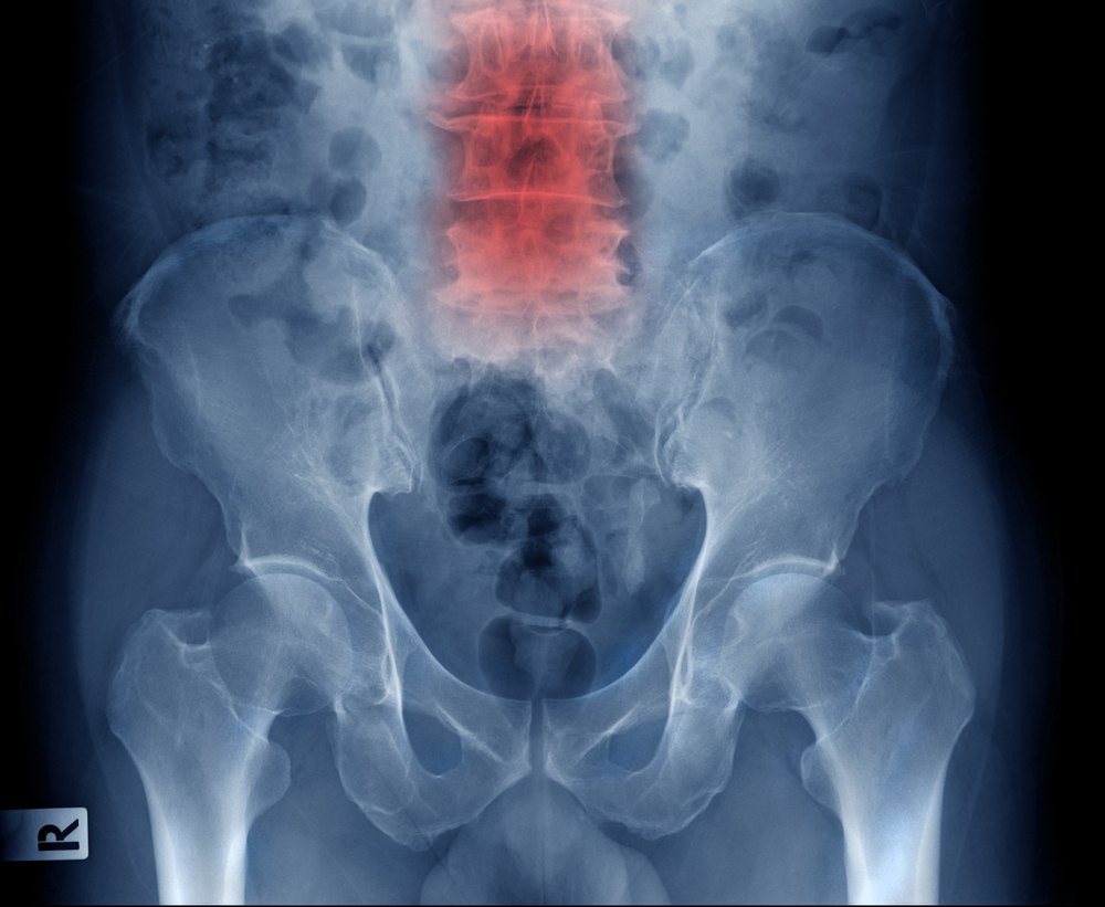 lumbar spinal stenosis