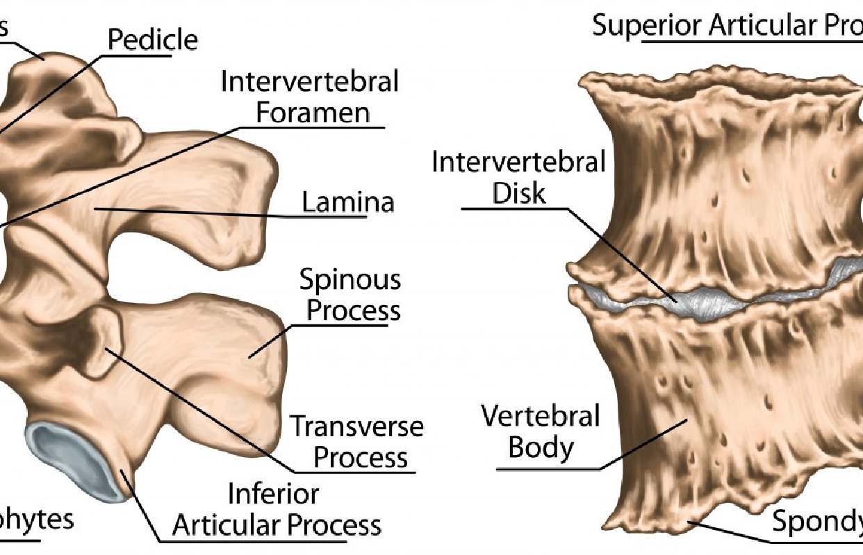 spinal fusion