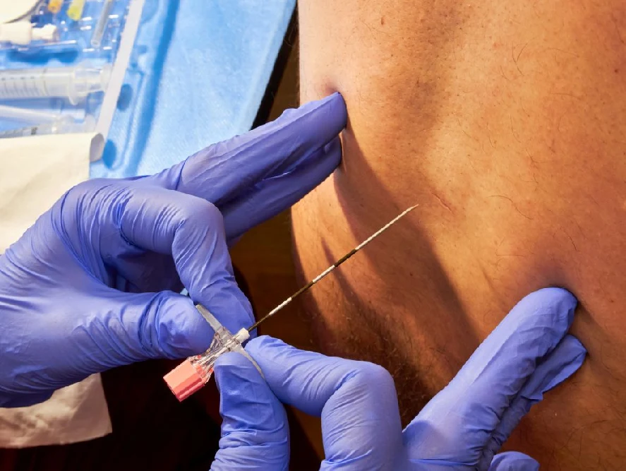 epidural injection to treat sciatica