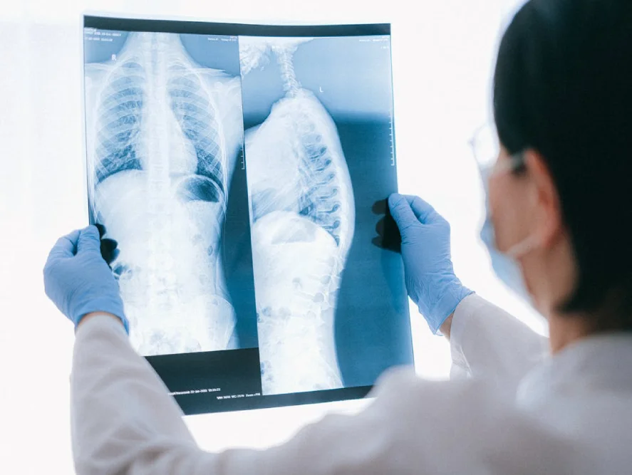 Spine Curvature Disorders