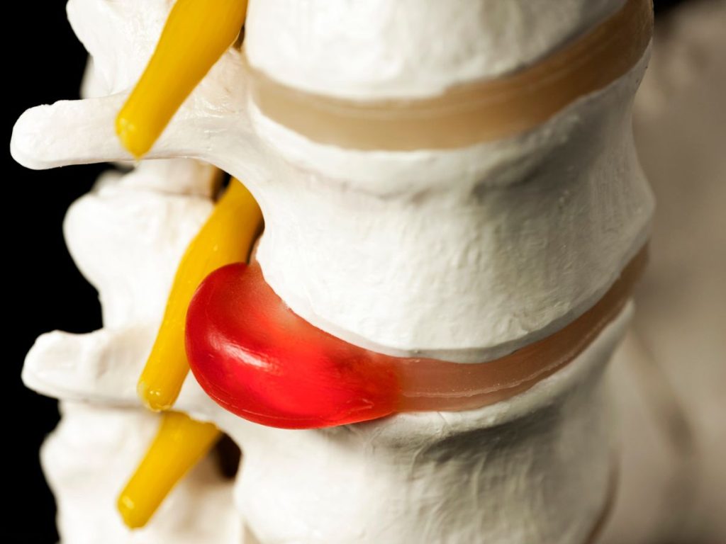The Best Treatments for Herniated Disc